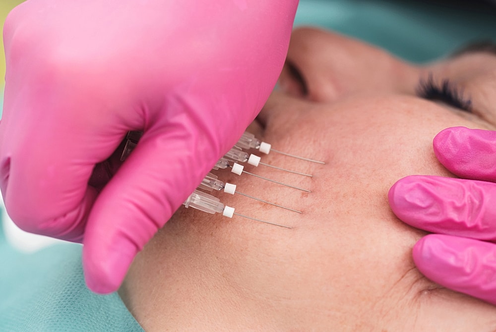 Injecting needles during cosmetic procedure on skin.