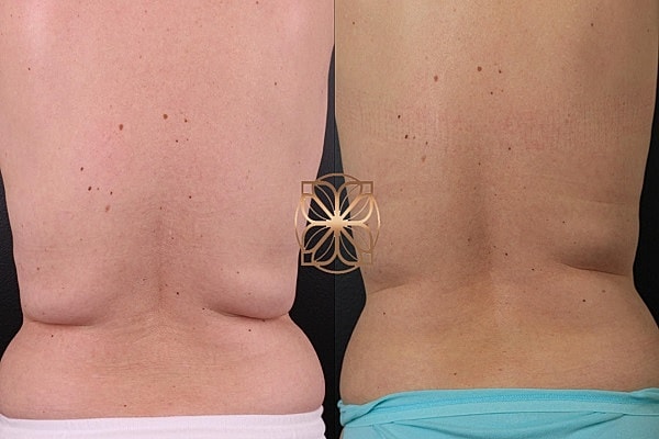 Before and after body contouring comparison image.