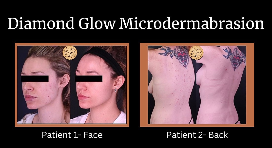 Before and after tummy tuck transformation.