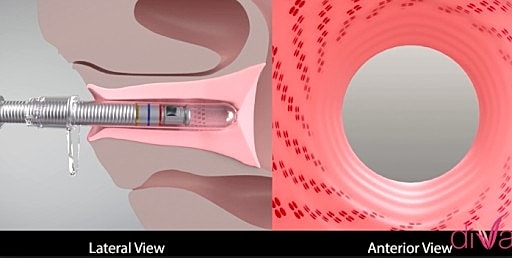 Lateral and anterior views of a medical device.
