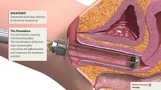 Dual laser delivery system for feminine treatments.