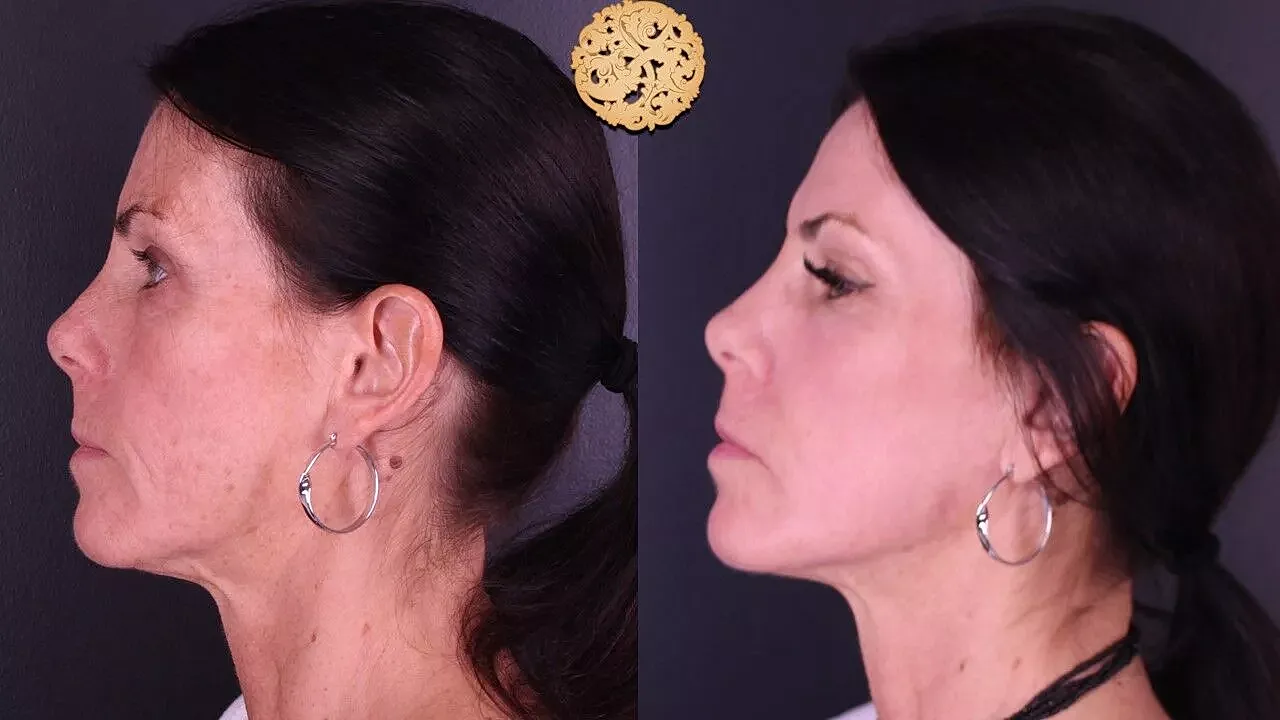 Before and after profile comparison of a woman.