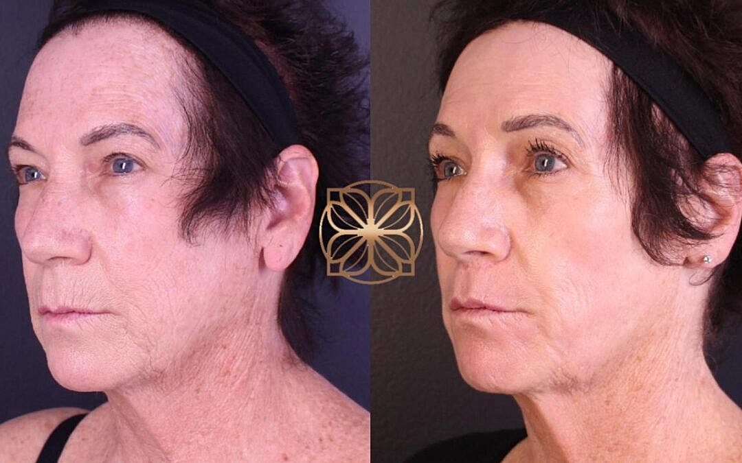 Before and after facial rejuvenation treatment.