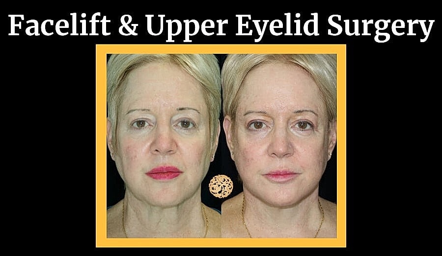 Before and after facelift and eyelid surgery.