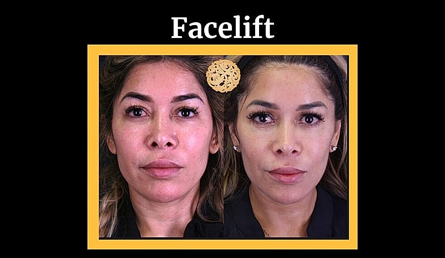 Before and after facelift comparison photo.