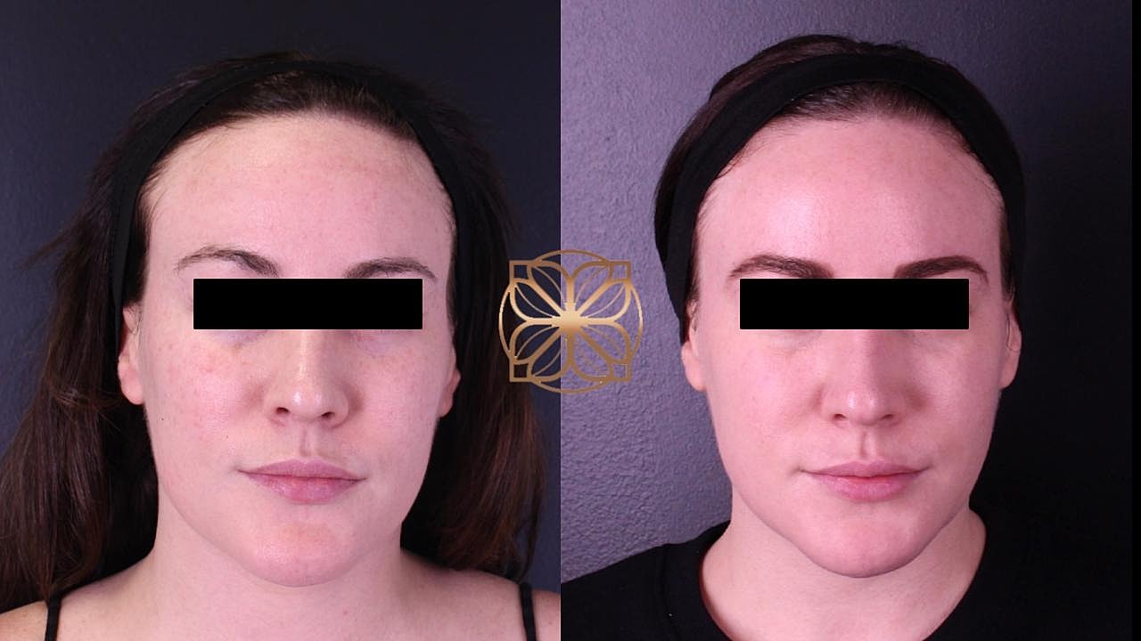 Before and after skincare treatment comparison.