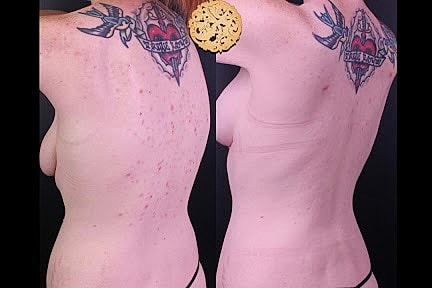 Before and after body tattoo comparison.