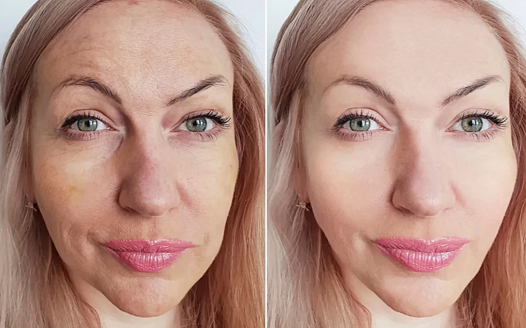 Before and after skin transformation comparison.