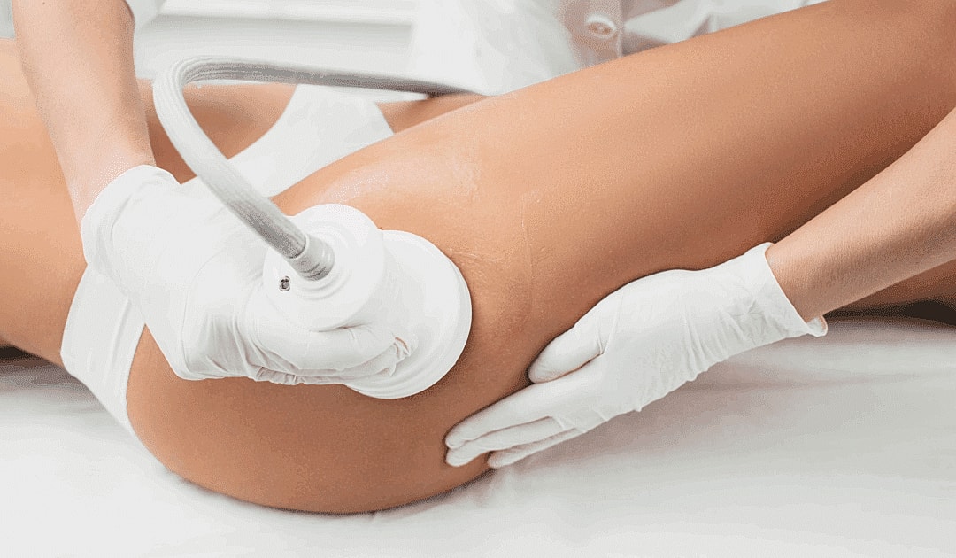 Body contouring treatment on a woman's thigh.