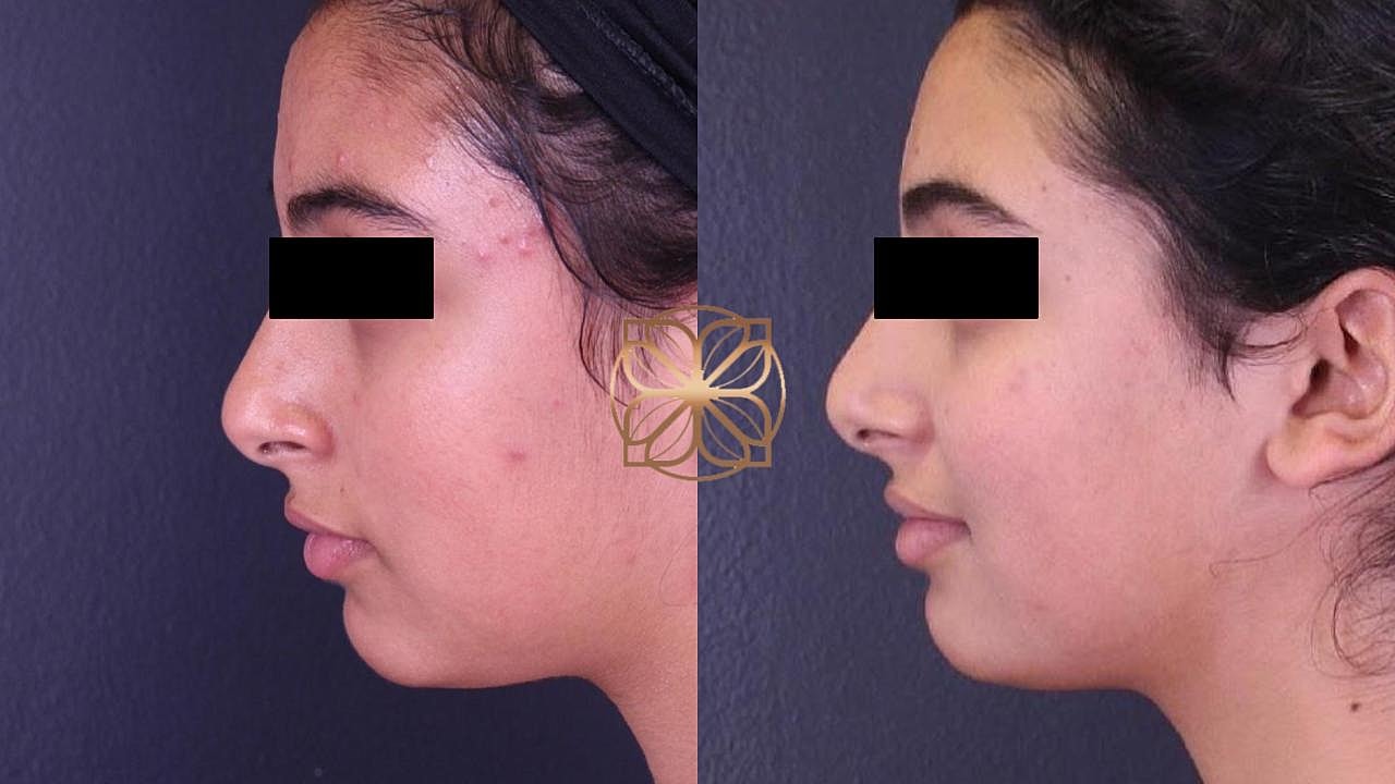 Before and after profile of a young woman.