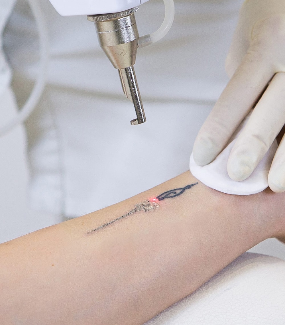 Laser tattoo removal in progress on arm.