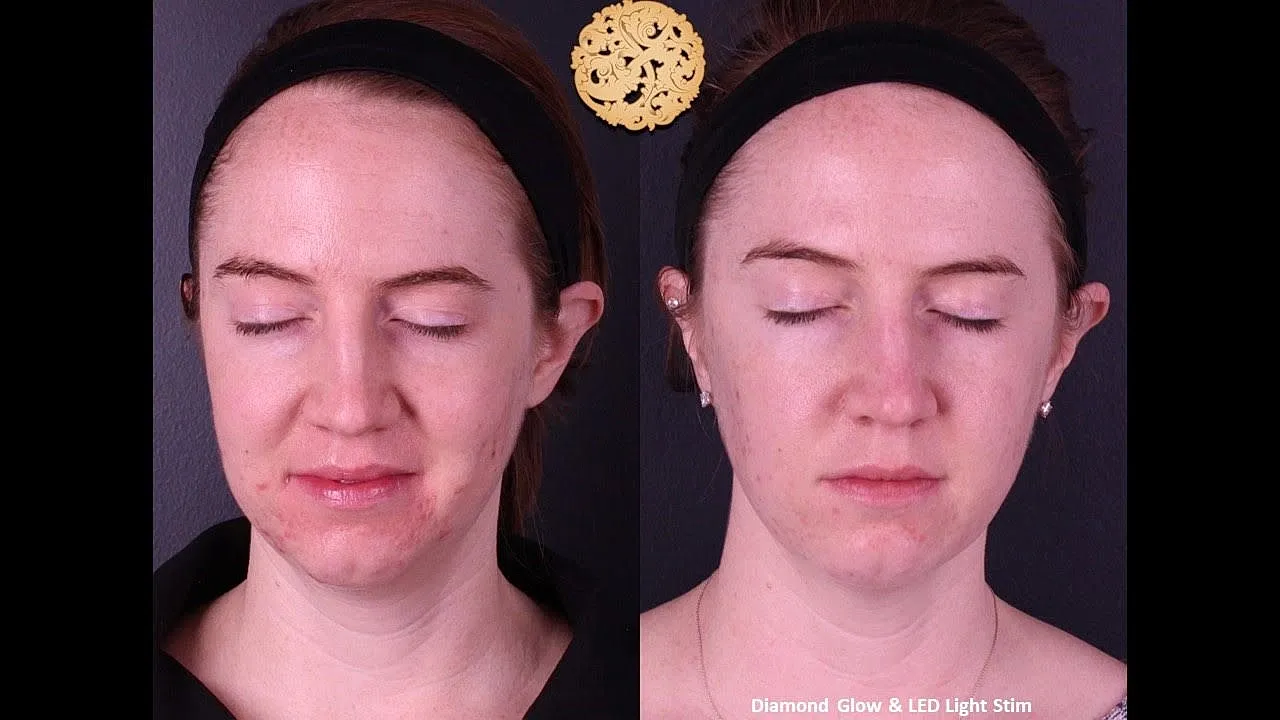 Before and after skincare treatment comparison.