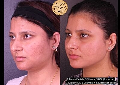 Before and after skin treatment comparison.