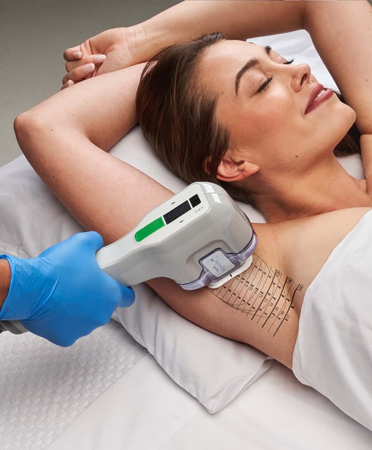 Woman undergoing aesthetic treatment on her arm.