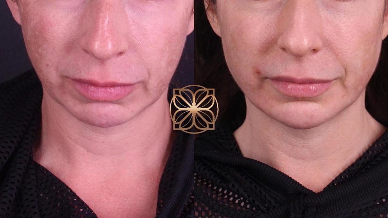Side-by-side comparison of skin texture improvement.