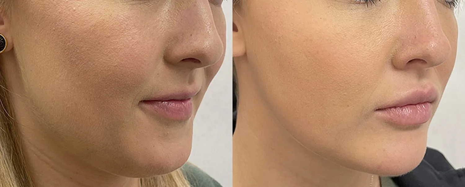 Before and after facial contouring comparison.