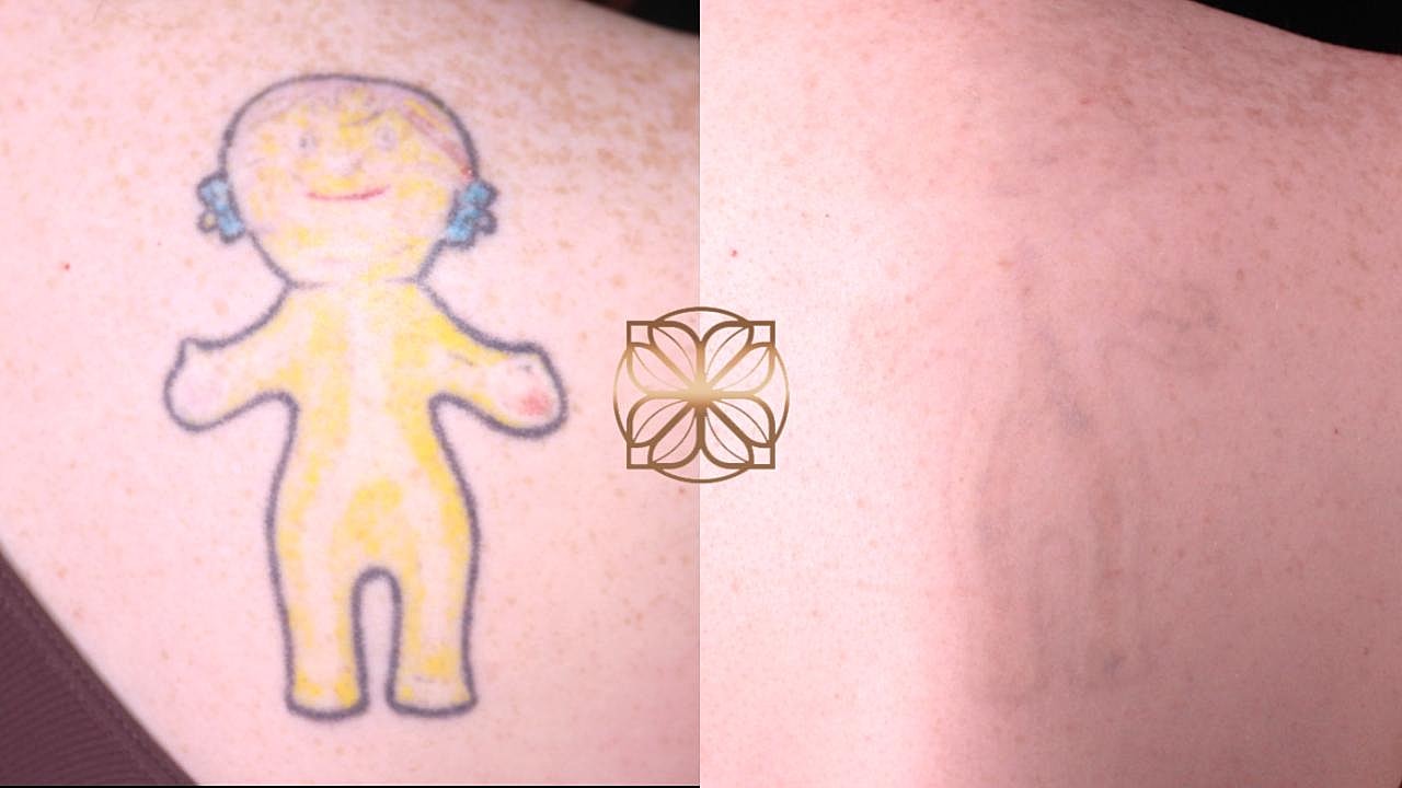 Tattoo fading over time on skin.