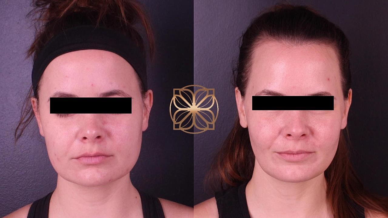 Contouring Gallery Before & After