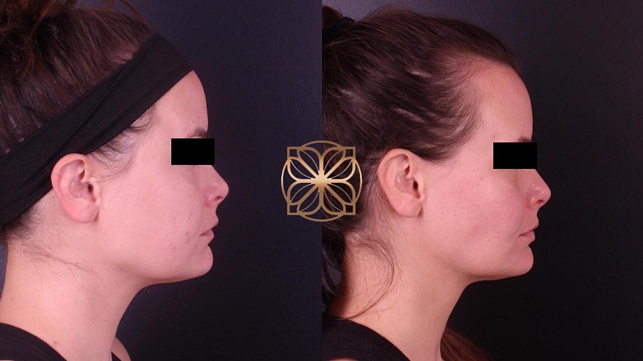Contouring Gallery Before & After