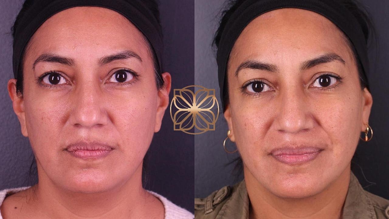Contouring Gallery Before & After