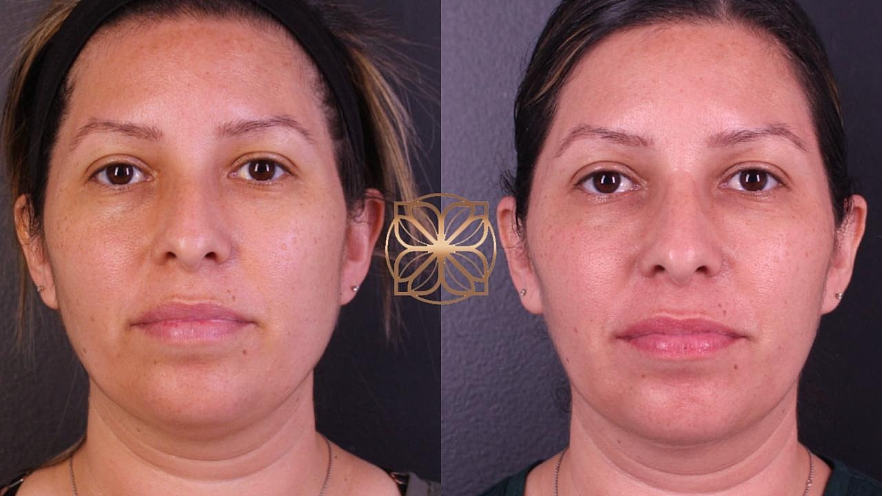 Contouring Gallery Before & After