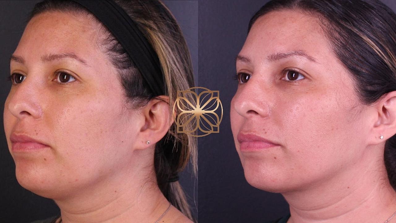 Contouring Gallery Before & After