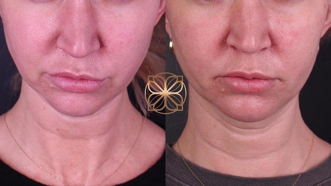 Contouring Gallery Before & After