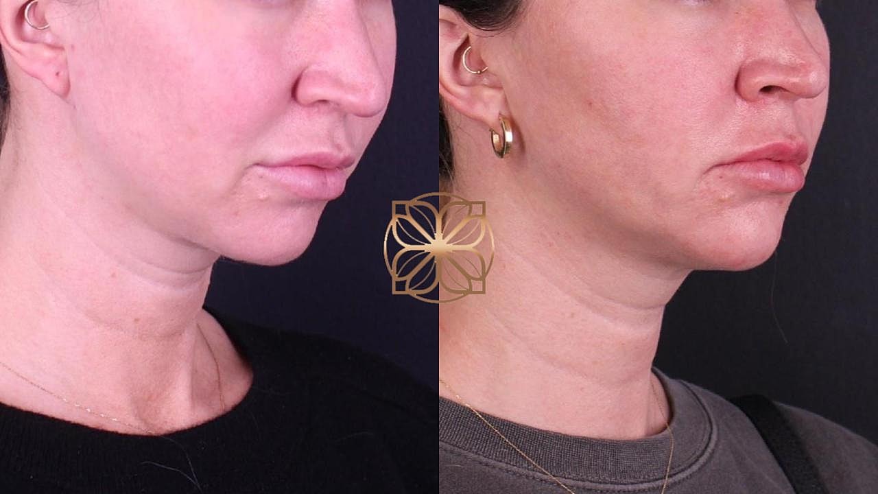 Contouring Gallery Before & After