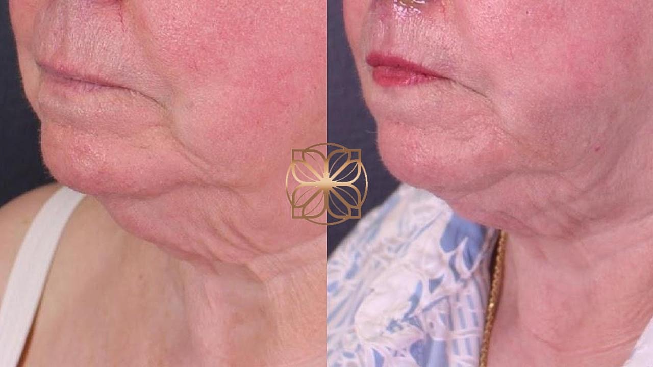 Contouring Gallery Before & After