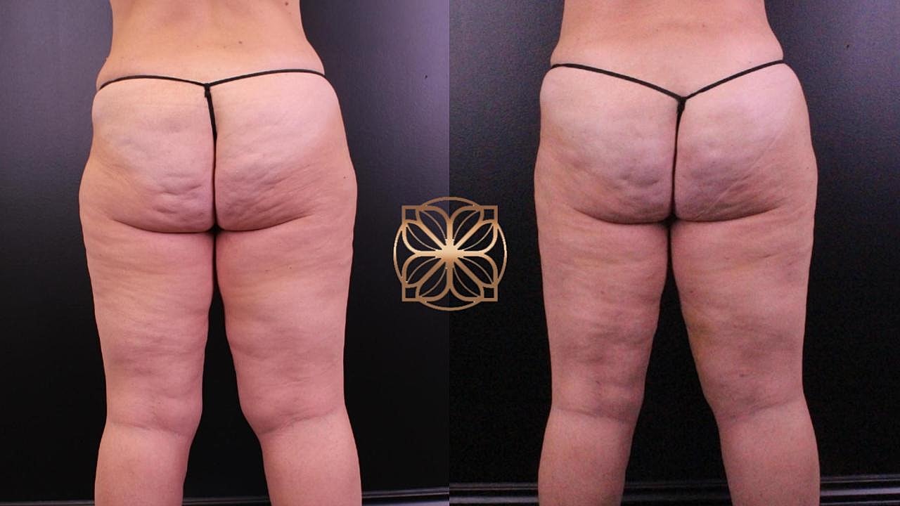 Contouring Gallery Before & After