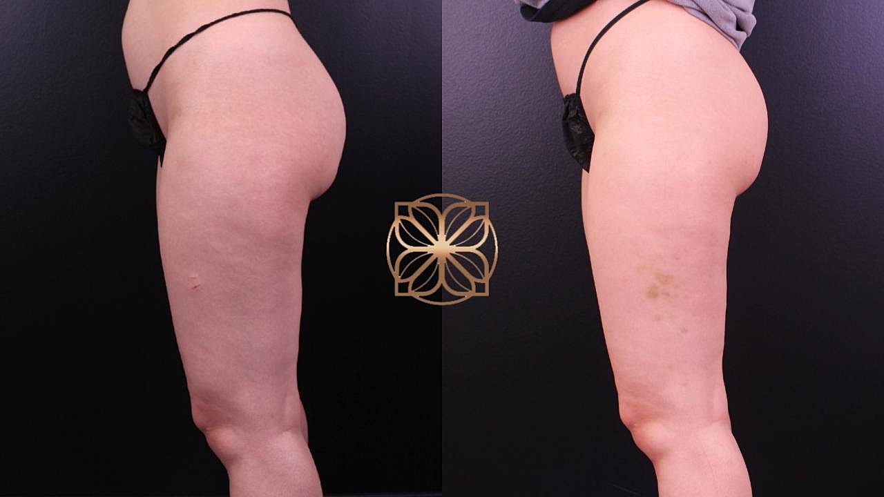 Contouring Gallery Before & After