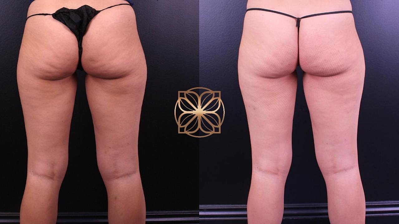 Contouring Gallery Before & After