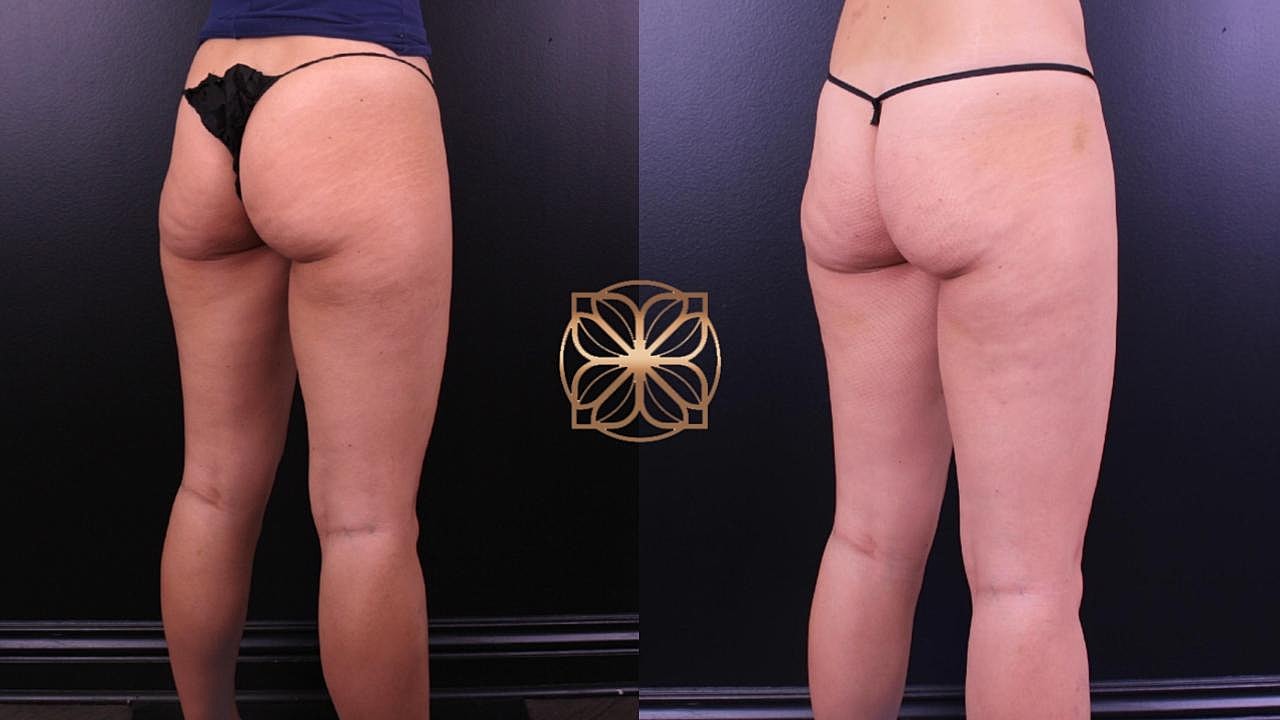 Contouring Gallery Before & After