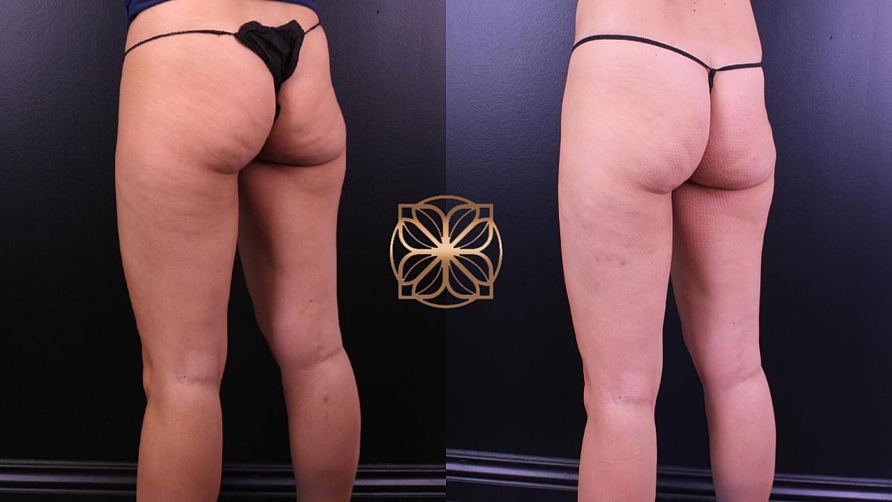 Contouring Gallery Before & After