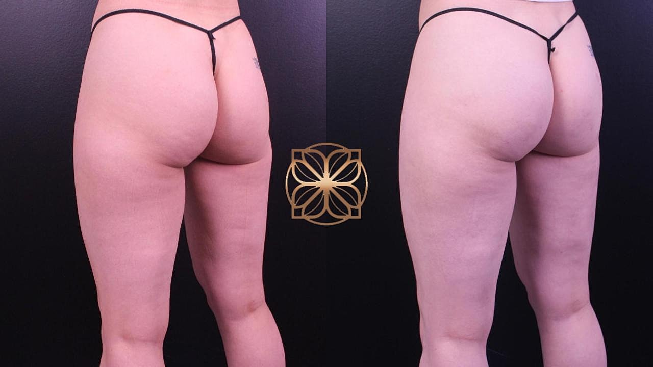 Contouring Gallery Before & After