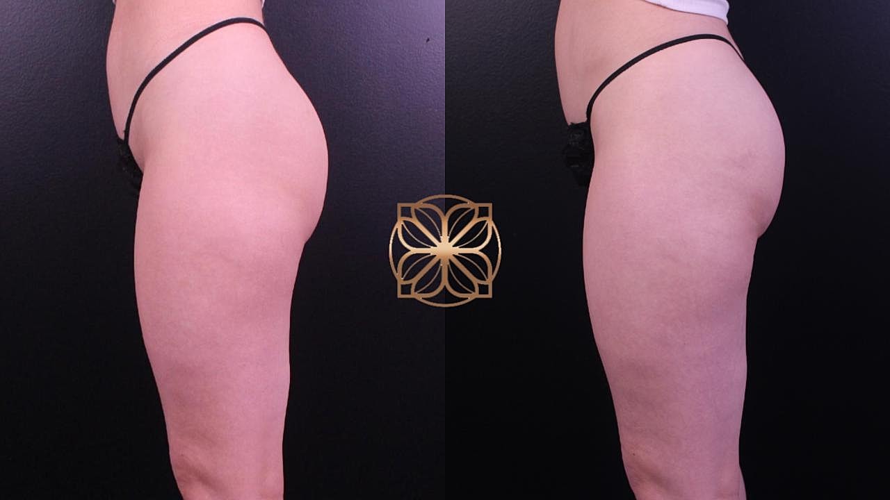 Contouring Gallery Before & After