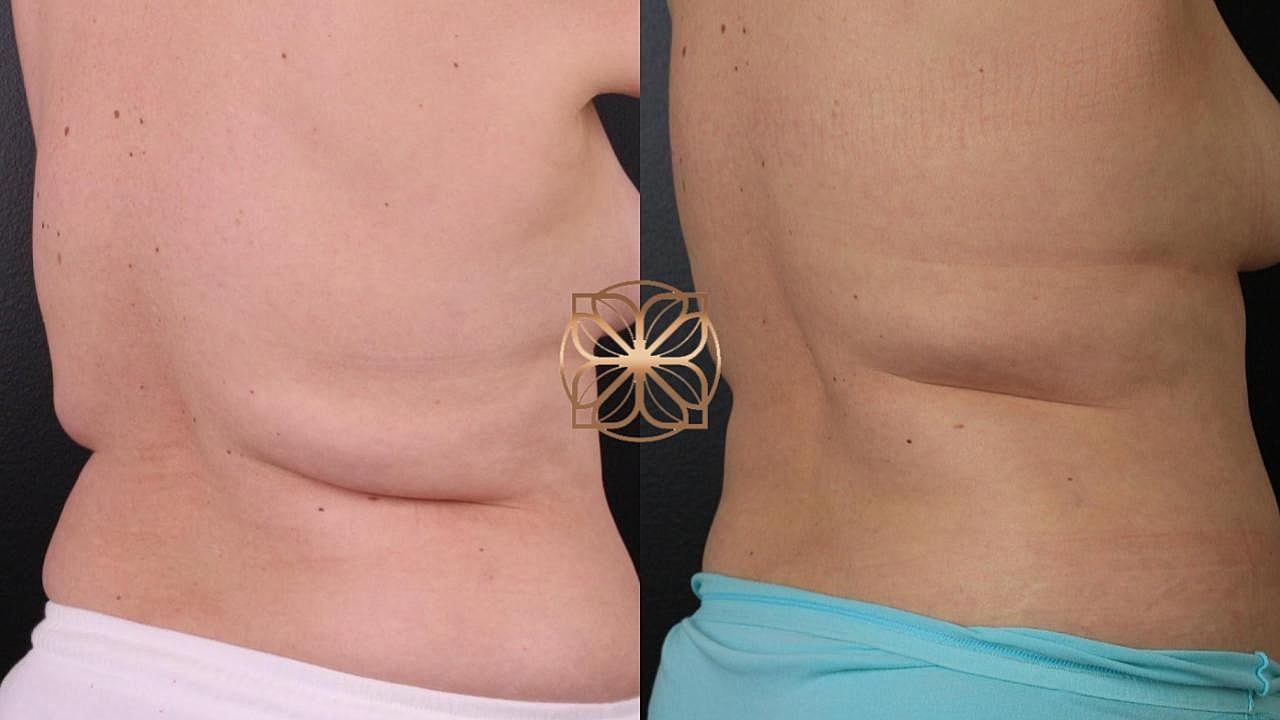 Contouring Gallery Before & After