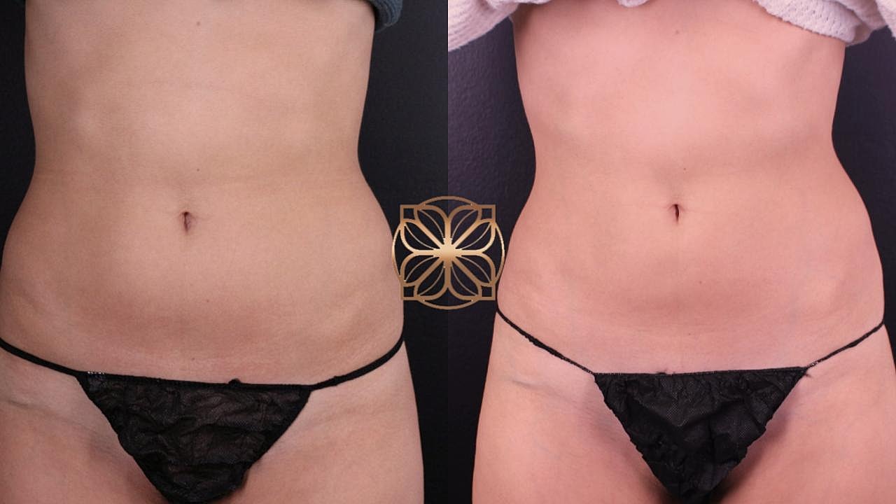 Contouring Gallery Before & After