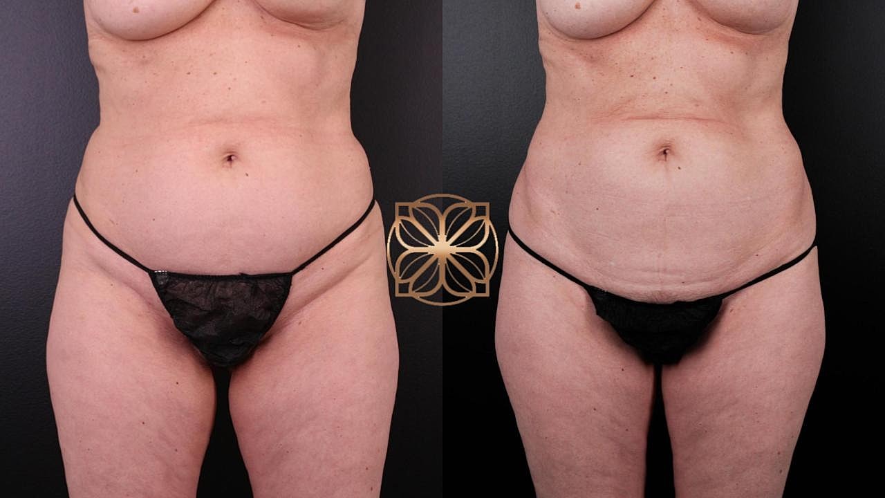 Contouring Gallery Before & After