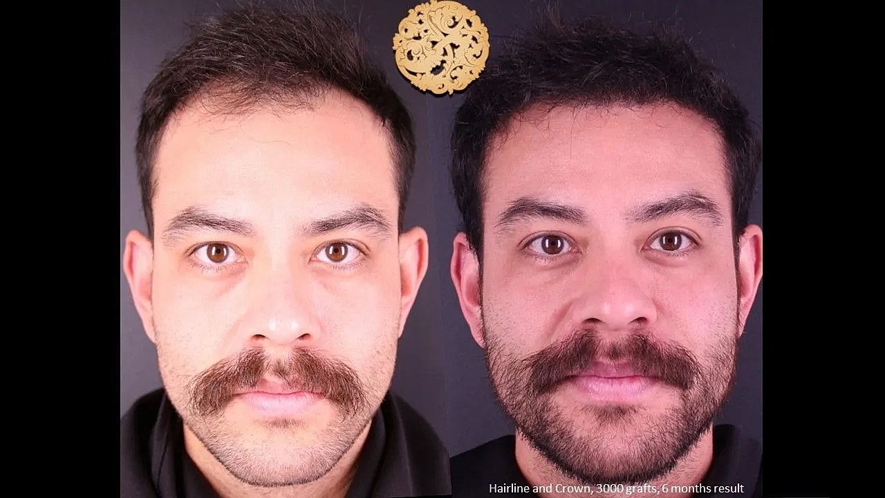 Contouring Gallery Before & After