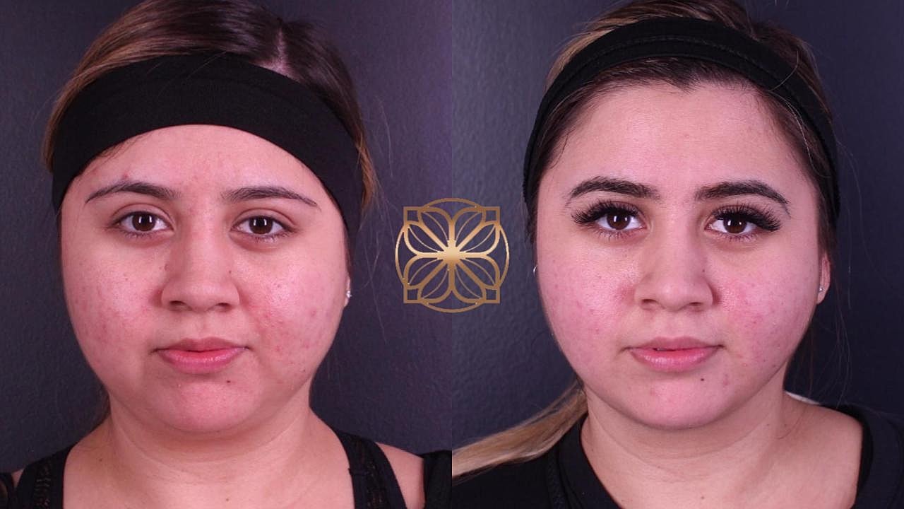 Coolsculpting Gallery Before & After