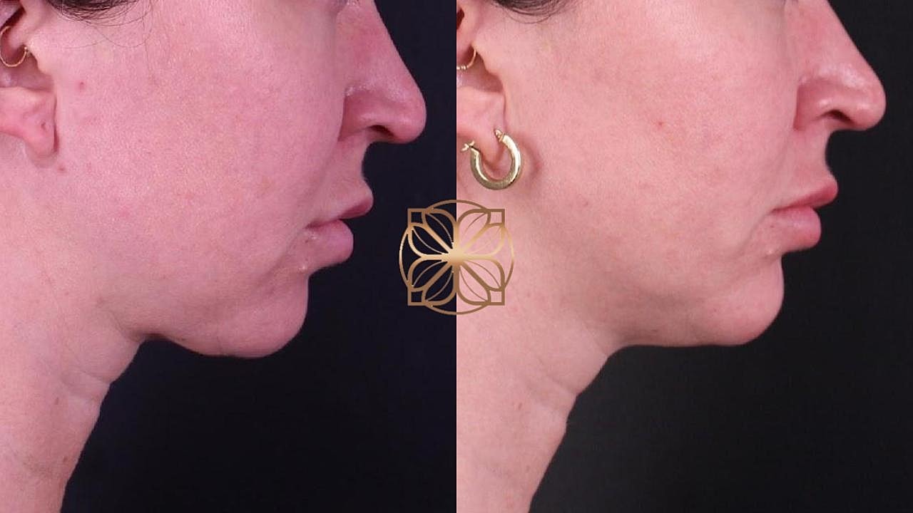 Coolsculpting Gallery Before & After