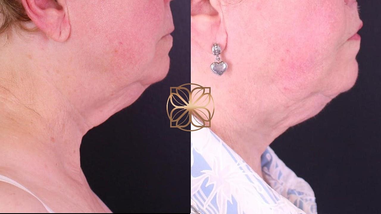 Coolsculpting Gallery Before & After