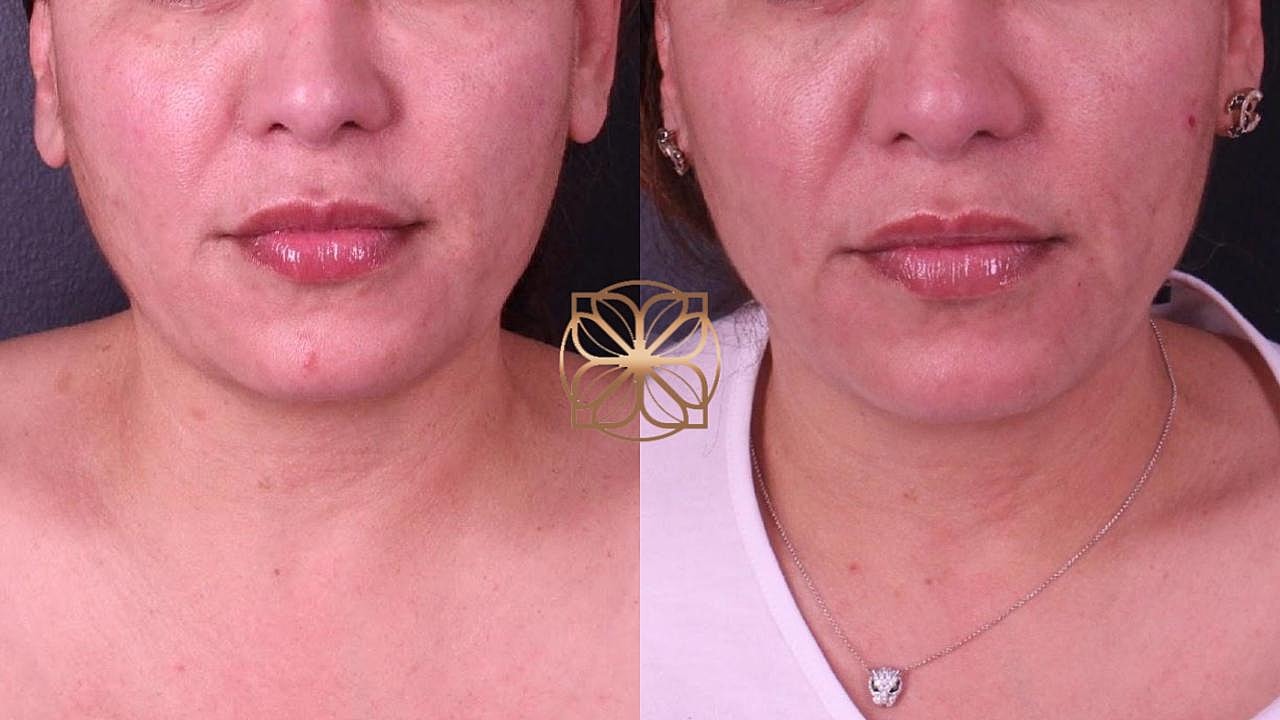 Coolsculpting Gallery Before & After