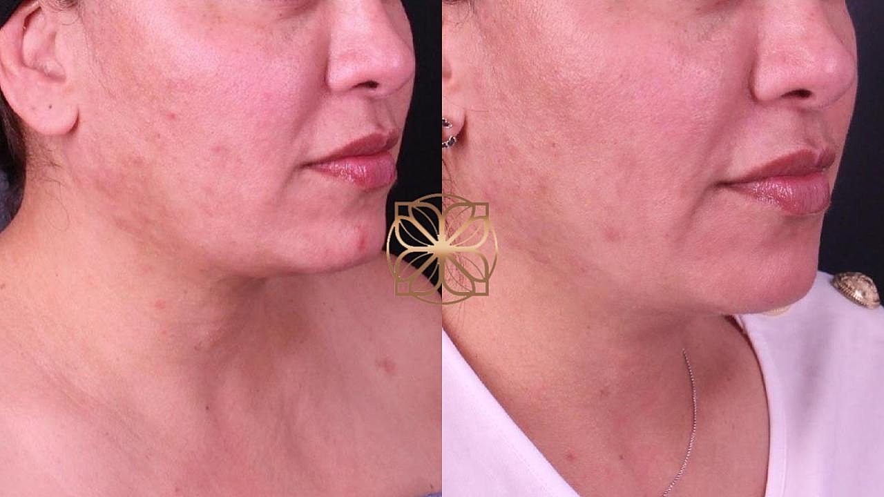 Coolsculpting Gallery Before & After