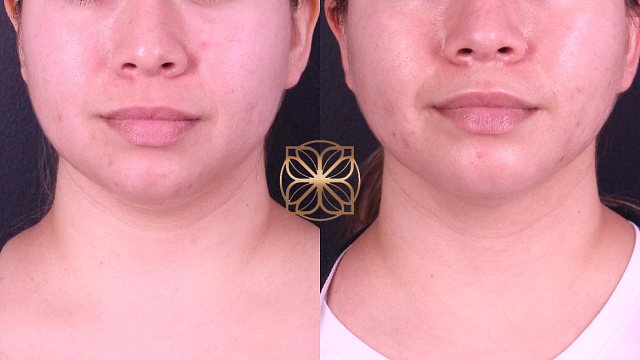 Coolsculpting Gallery Before & After