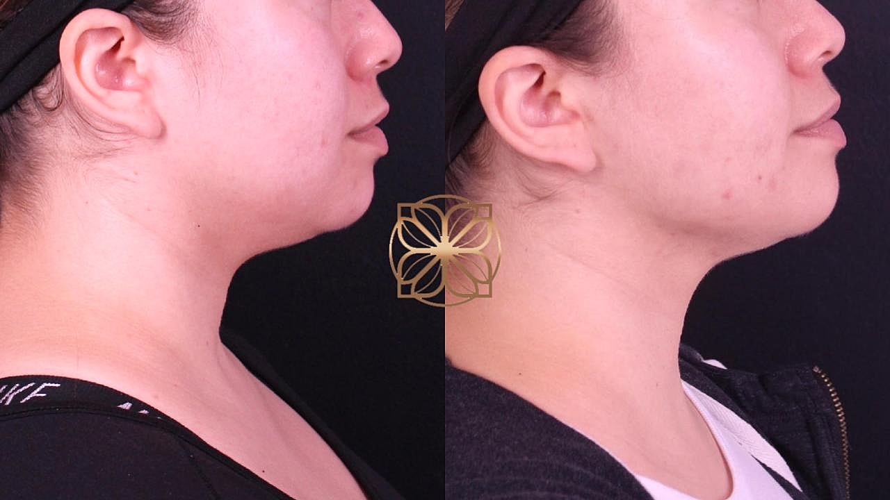 Coolsculpting Gallery Before & After