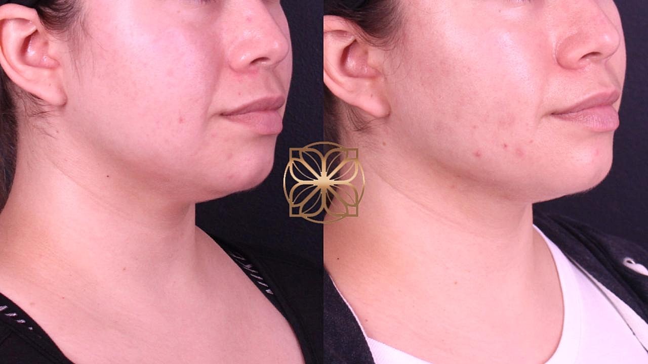 Coolsculpting Gallery Before & After