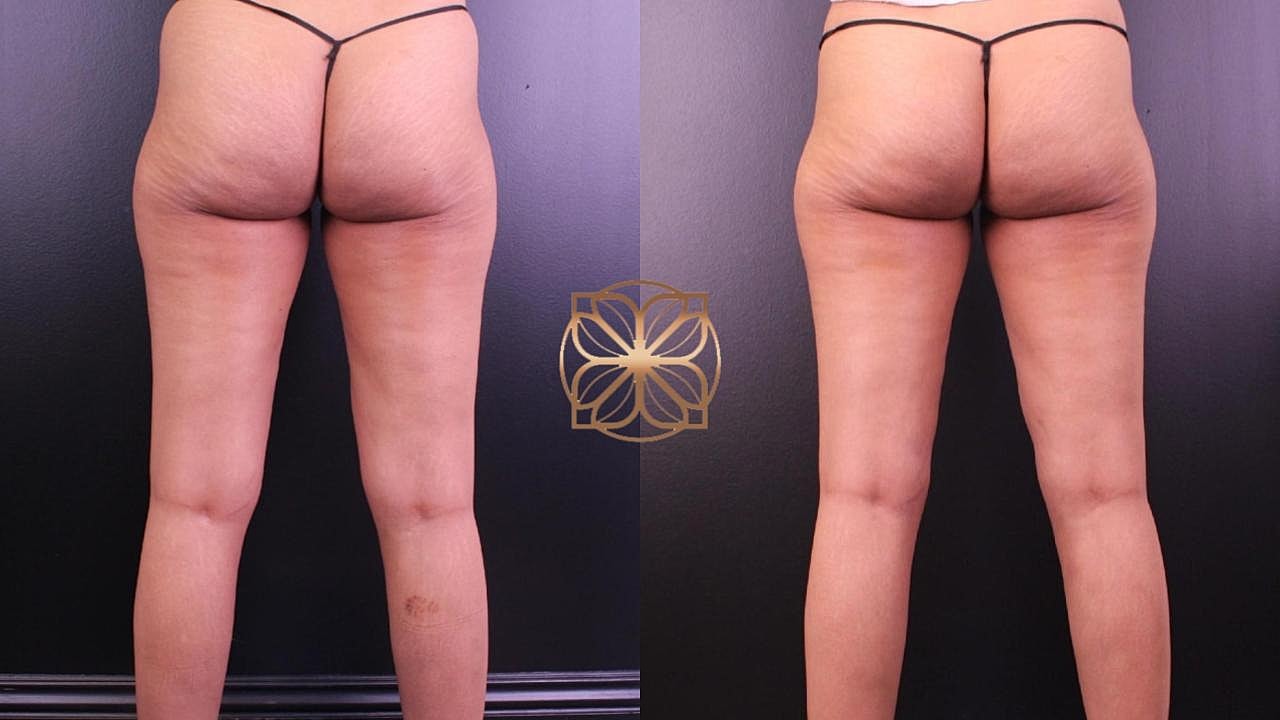 Coolsculpting Gallery Before & After
