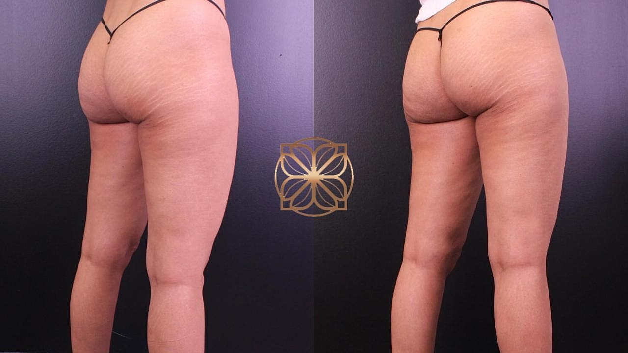 Coolsculpting Gallery Before & After